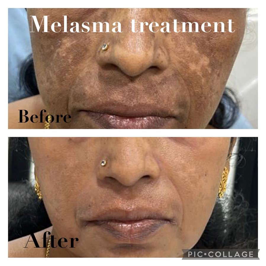 Treatment 3