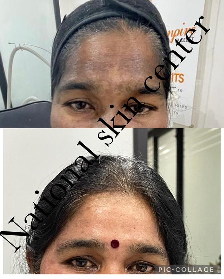 Treatment 2